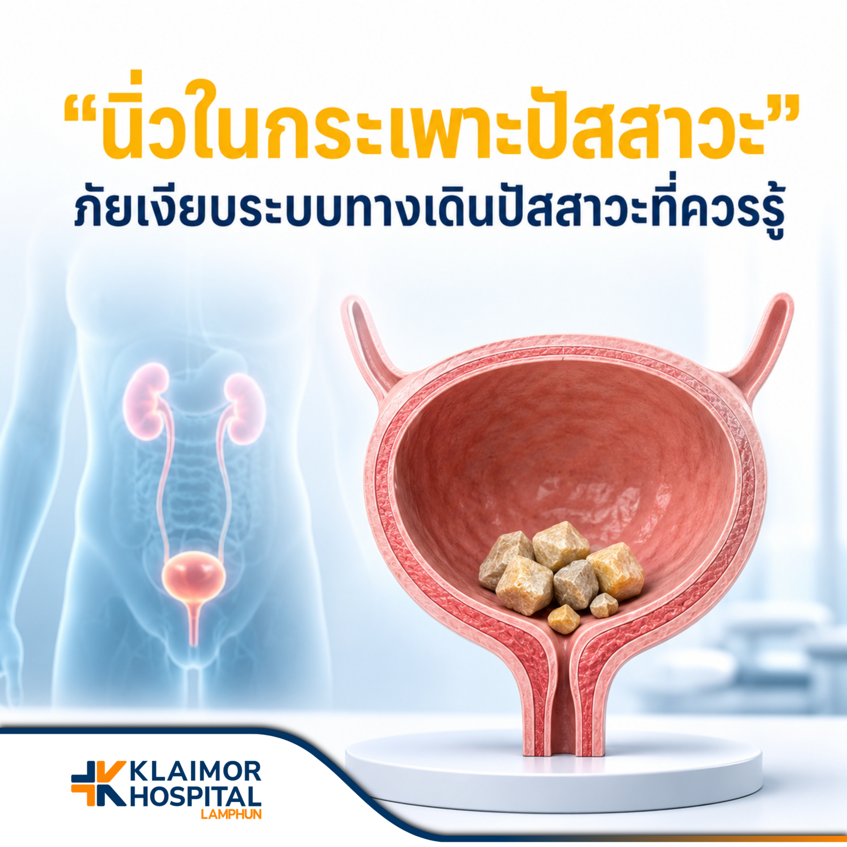 นิ่วในกระเพาะปัสสาวะ ภัยเงียบระบบทางเดินปัสสาวะที่ควรรู้